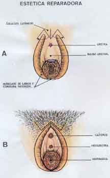 vulvoplastia
